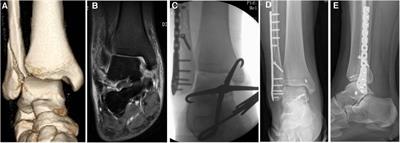 Repair of deep deltoid ligament ruptures near the medial malleolar attachment or midsubstance rupture by using suture anchors into the talus combined with the transosseous suture in the medial malleolar